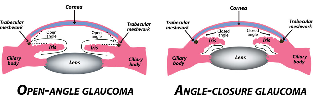 Chart Showing Open-Angle and Angle-Closure Glaucoma